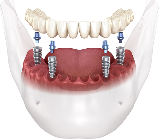All On X Dental Implants