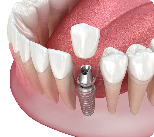 Single Dental Implant