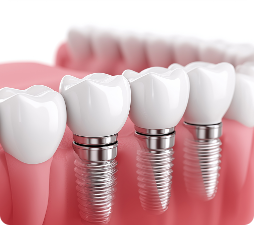 Multi-Implant Bridge