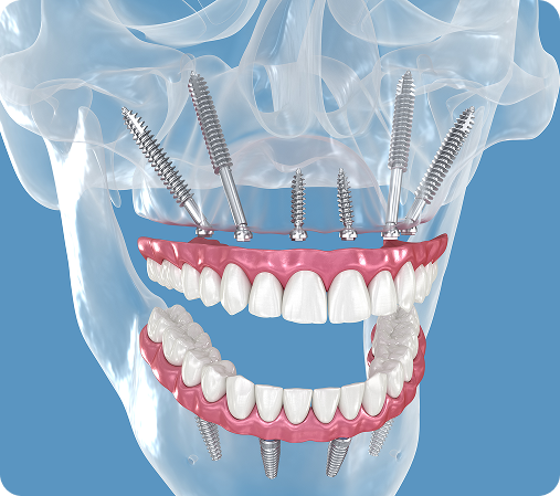 Zygomatic Dental Implants